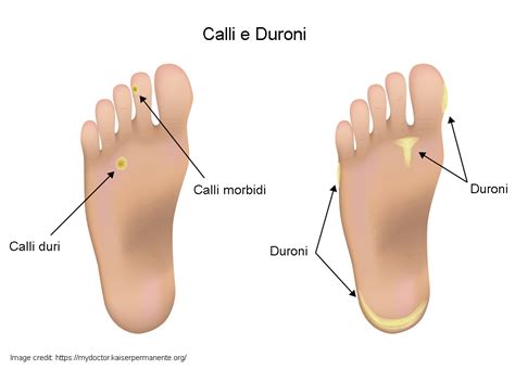 Calli e duroni